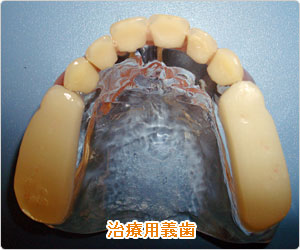 治療用義歯