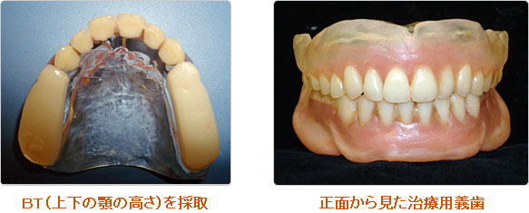 治療用の仮入れ歯の製作（治療用義歯製作）
