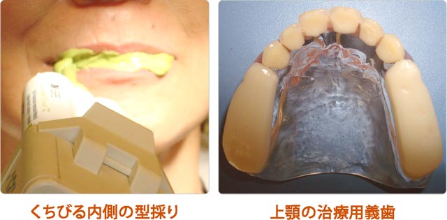 治療用の仮入れ歯の製作（治療用義歯製作）