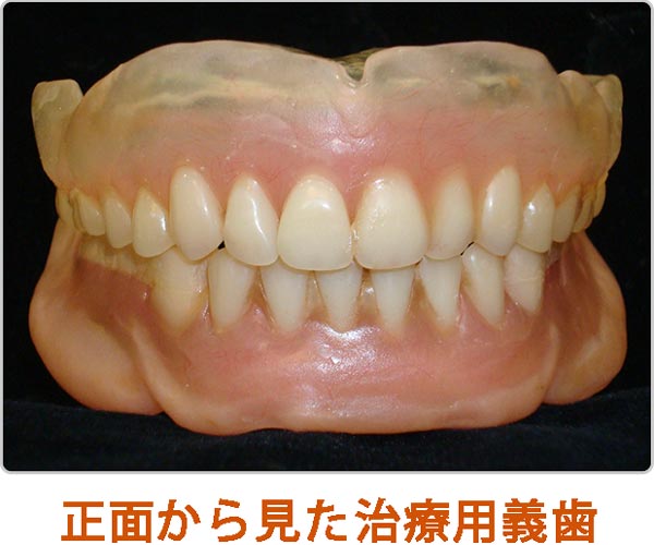 超精密義歯の完成
